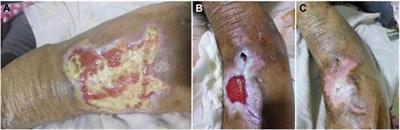 Therapeutic Effect of Epidermal Growth Factor Combined With Nano Silver Dressing on Diabetic Foot Patients